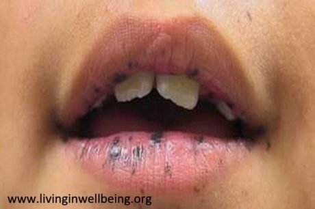 Black Spots on Lips? What Should You Do? - Living In Well Being